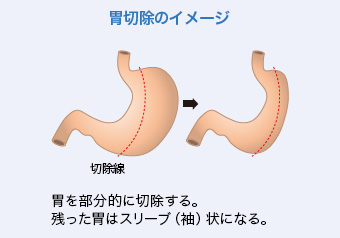 胃切除のイメージ
