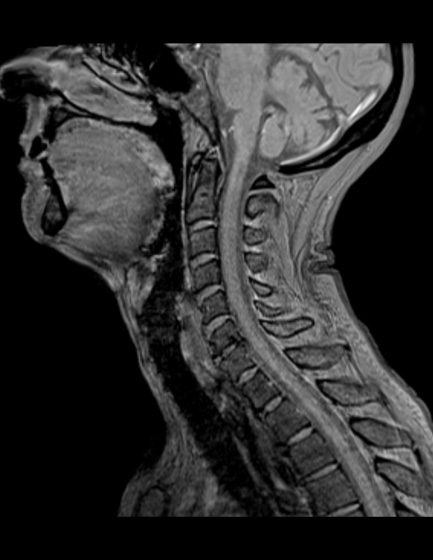 頸椎（矢状断）