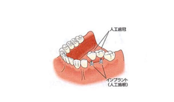 インプラント