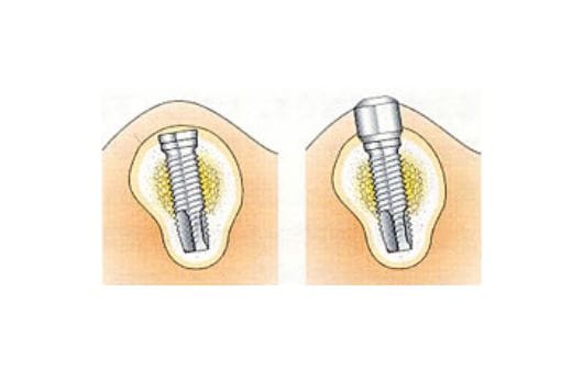 二次手術