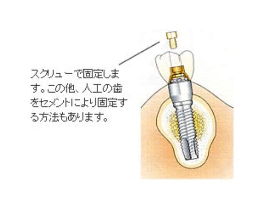 人工歯の装着