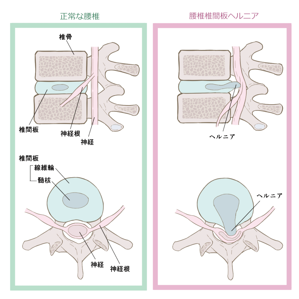 ヘルニア 治る のか