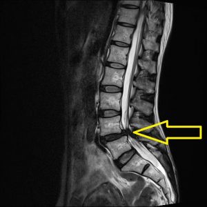 10 腰部脊柱管狭窄症のあれこれ 手術すべきかどうか チーム脳外 脳神経外科医のブログ