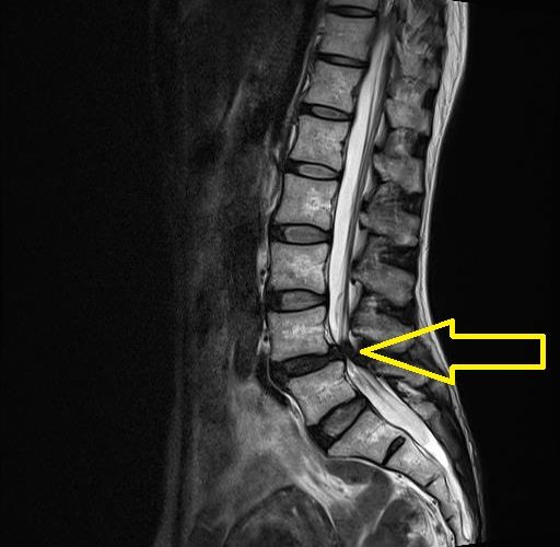 10 腰部脊柱管狭窄症のあれこれ 手術すべきかどうか チーム脳外 脳神経外科医のブログ