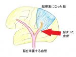 12．脳梗塞の再発は、元から絶たなきゃダメ ― 抗凝固薬の話 ―
