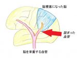 12. 脳梗塞の再発は、元から絶たなきゃダメ<br>―抗凝固薬の話