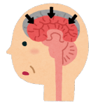 14．物忘れと認知症