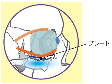 16 眼窩底骨折について チーム脳外 脳神経外科医のブログ