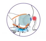 16．眼窩底骨折について