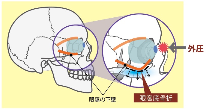 16 眼窩底骨折について チーム脳外 脳神経外科医のブログ