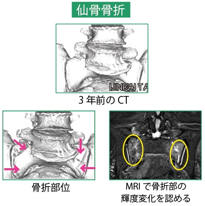 17 骨盤脆弱性骨折とは 太ももの付け根の痛み ひょっとして骨盤や仙骨の骨折かも チーム脳外 脳神経外科医のブログ