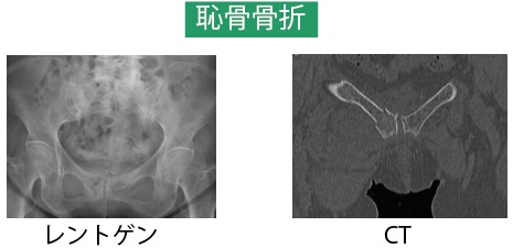 17 骨盤脆弱性骨折とは 太ももの付け根の痛み ひょっとして骨盤や仙骨の骨折かも チーム脳外 脳神経外科医のブログ