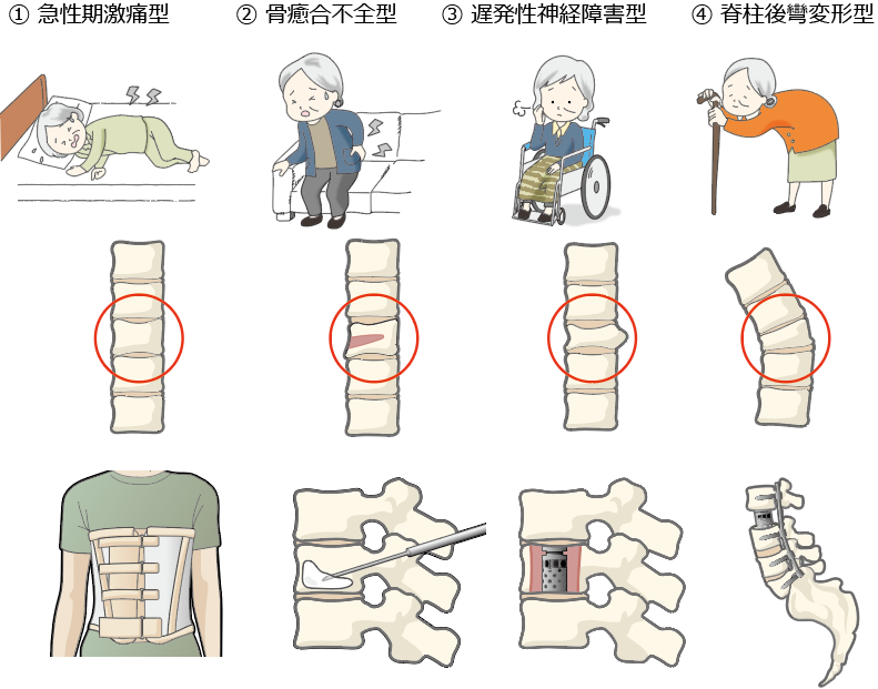 骨盤骨折とは何ですか？