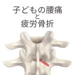 28．子どもの腰痛　それ、疲労骨折かもです　ひねりに注意