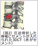 Q．脊椎圧迫骨折に対するセメント治療とは