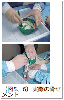 Q．局所麻酔でおこなうセメント治療（PVP）の具体的な方法