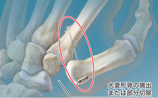 ミニタイトロープを用いたCM関節形成術