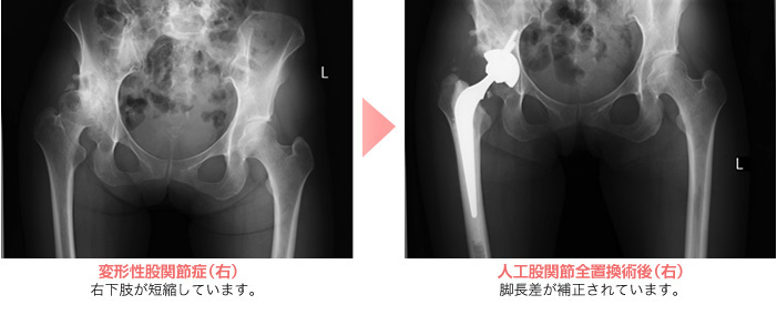 人工関節置換術とは