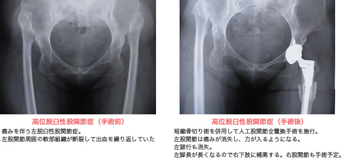 人工関節置換術とは