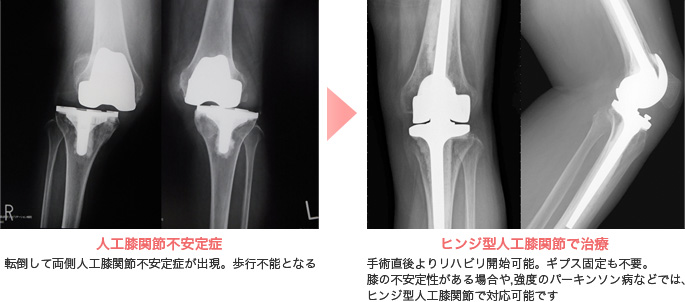 人工関節置換術とは