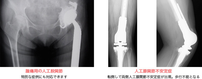 人工関節置換術とは