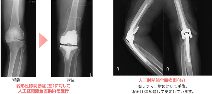 人工関節置換術とは