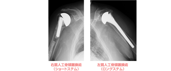 人工関節置換術とは