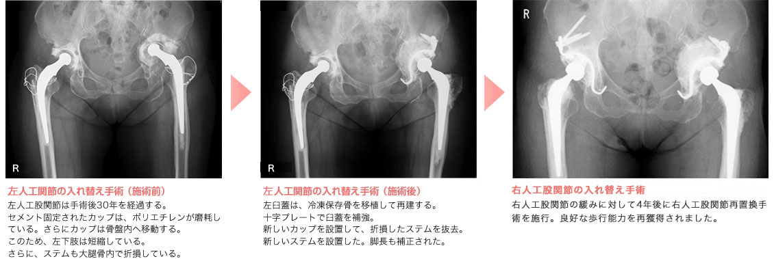 人工関節置換術とは