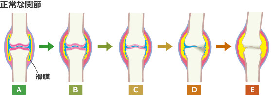 関節が変形するのはなぜ？