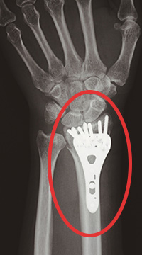 橈骨遠位端ハイブリッドロッキングプレート 十条武田リハビリテーション病院 武田病院グループ