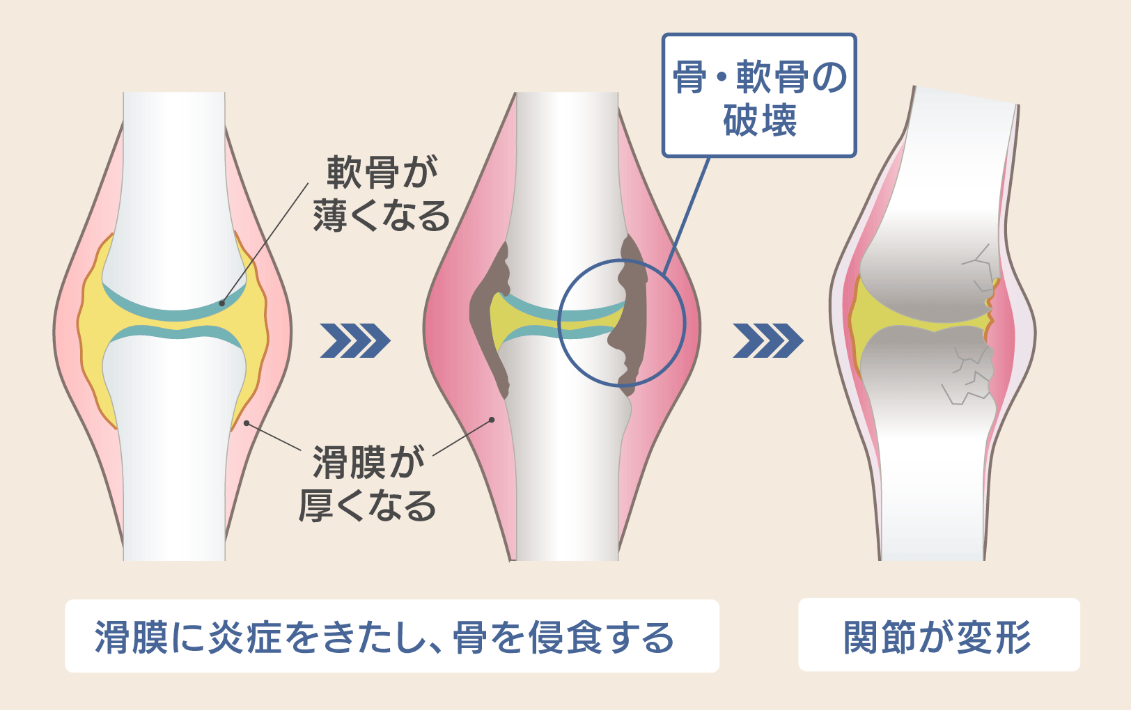関節リウマチの進行