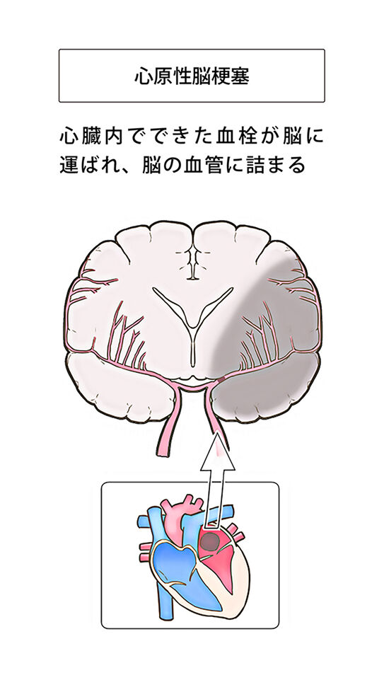 心原性脳梗塞 イメージ図