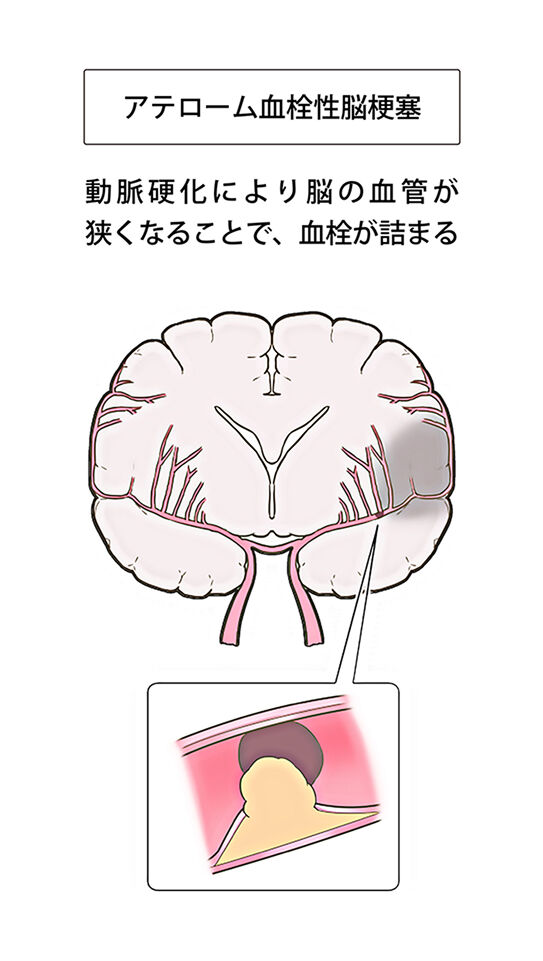 アテローム血栓性脳梗塞 イメージ図