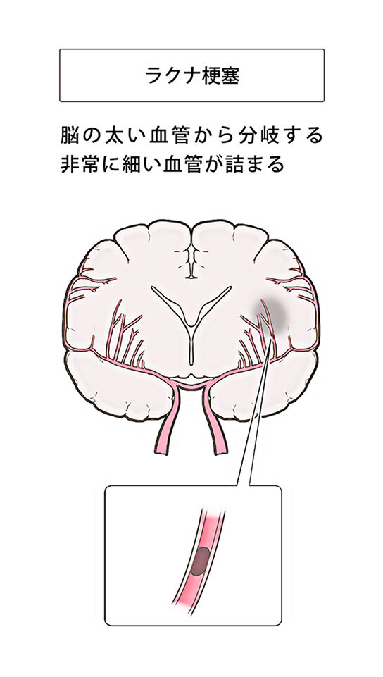 ラクナ梗塞 イメージ図