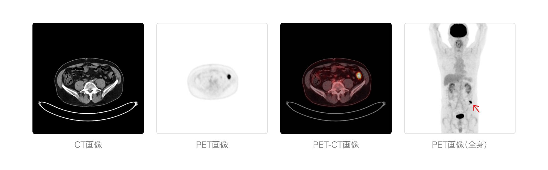 PET-CT検査 図