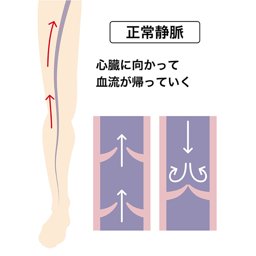 下肢静脈瘤 正常静脈 イメージ図