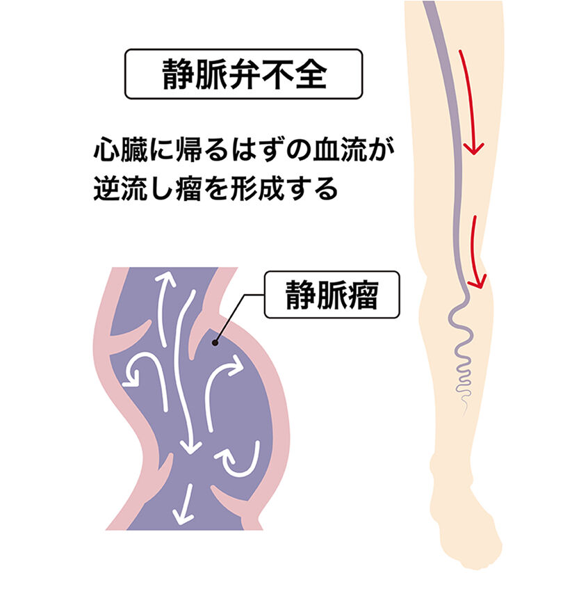 下肢静脈瘤 静脈弁不全 イメージ図