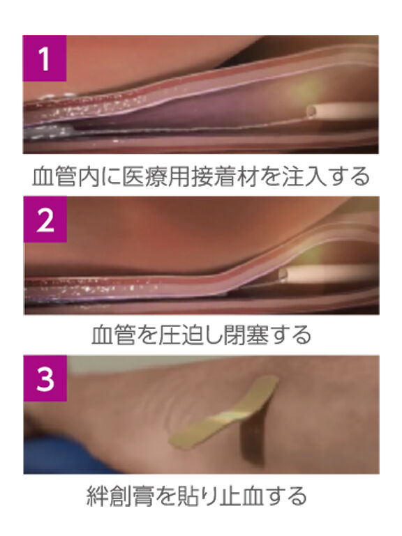 VenaSealの手技（グルー治療） 手順
