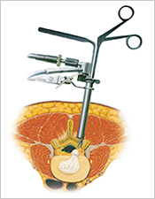 脊椎内視鏡下手術システム（MED／Medtronic社）のイラスト