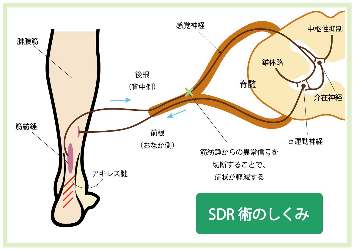 https://www.takedahp.or.jp/publicity/items/SDR%E3%81%A8%E3%81%AF.jpg