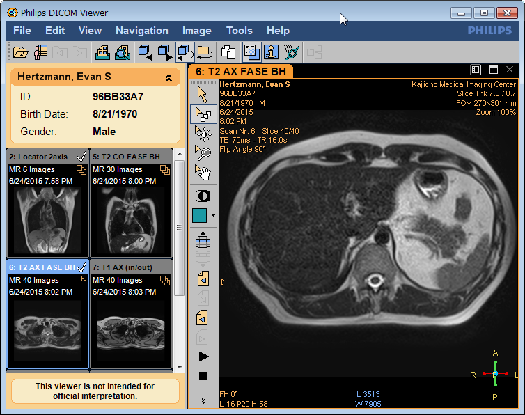 SnapCrab_Philips DICOM Viewer_2015-7-31_10-18-9_No-00.png