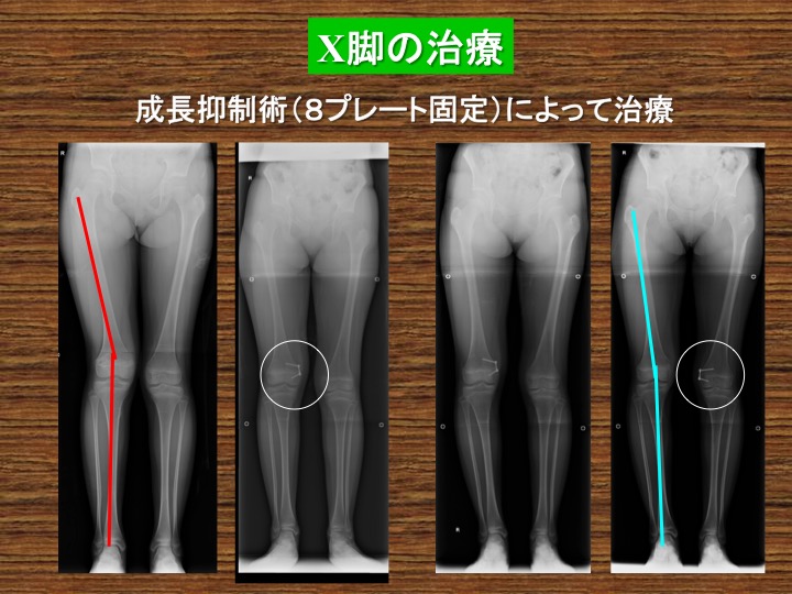 小児運動器・イリザロフ外来｜整形外科｜診療科・部門紹介｜外来受診